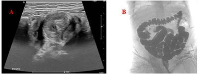 Intussusception in an Infant With SARS-CoV-2 Infection: A Case Report and a Review of the Literature